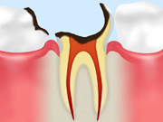 ［画像］C4～歯根に達した虫歯～